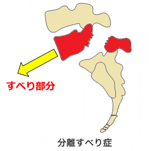 腰椎分離症を整体で改善した野球選手の話 整体院監修 東葉コンディショニングブログ