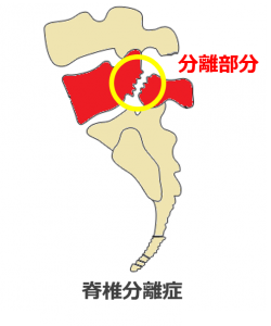 腰椎分離症を整体で改善した野球選手の話 整体院監修 東葉コンディショニングブログ